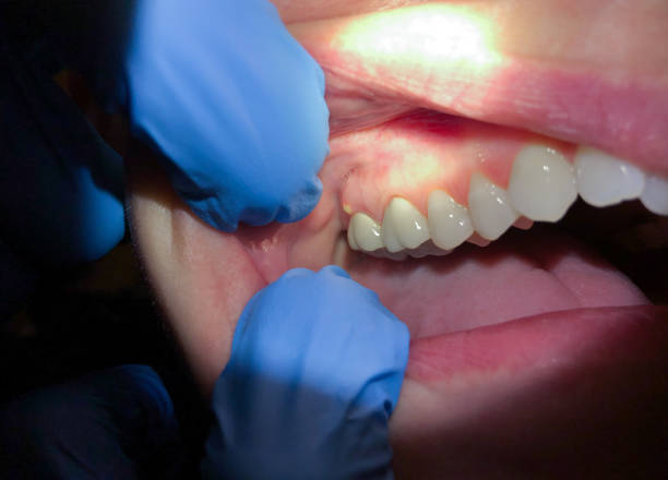 Best Cracked Tooth Emergency Dentist  in Divernon, IL