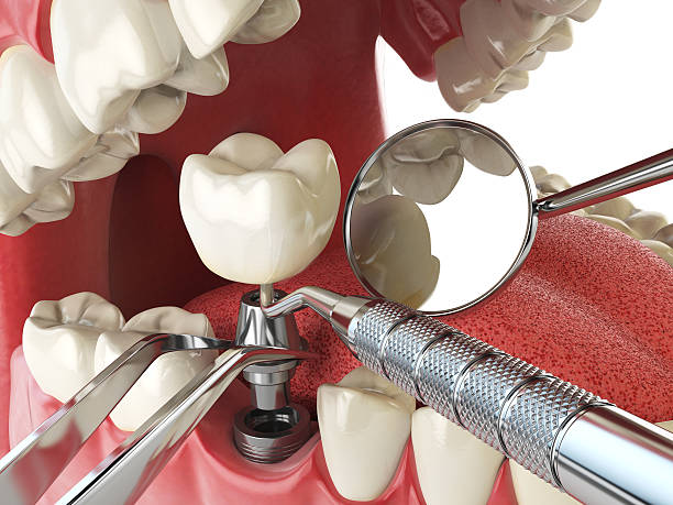 Best Chipped Tooth Repair Near Me  in Divernon, IL
